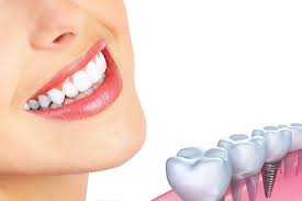 Dental-Implants-Philadelphia-County
